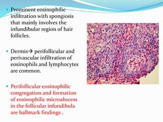  Prominent eosinophilic
infiltration with spongiosis
that mainly involves the
infundibular region of hair
follicles.
 Dermis perifollicular and
perivascular infiltration of
eosinophils and lymphocytes
are common.
 Perifollicular eosinophilic
congregation and formation
of eosinophilic microabscess
in the follicular infundibula
are hallmark findings .
 