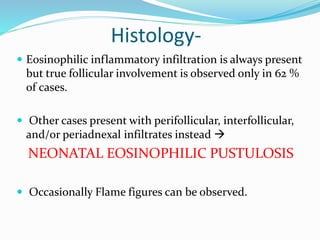 Histology-
 Eosinophilic inflammatory infiltration is always present
but true follicular involvement is observed only in 62 %
of cases.
 Other cases present with perifollicular, interfollicular,
and/or periadnexal infiltrates instead 
NEONATAL EOSINOPHILIC PUSTULOSIS
 Occasionally Flame figures can be observed.
 
