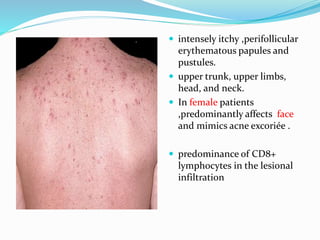  intensely itchy ,perifollicular
erythematous papules and
pustules.
 upper trunk, upper limbs,
head, and neck.
 In female patients
,predominantly affects face
and mimics acne excoriée .
 predominance of CD8+
lymphocytes in the lesional
infiltration
 