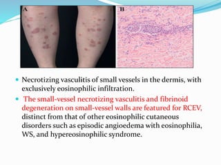  Necrotizing vasculitis of small vessels in the dermis, with
exclusively eosinophilic infiltration.
 The small-vessel necrotizing vasculitis and fibrinoid
degeneration on small-vessel walls are featured for RCEV,
distinct from that of other eosinophilic cutaneous
disorders such as episodic angioedema with eosinophilia,
WS, and hypereosinophilic syndrome.
 