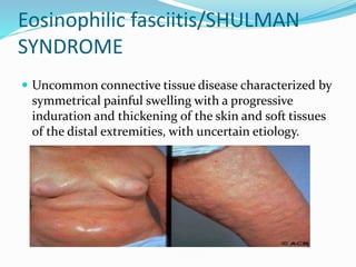Eosinophilic fasciitis/SHULMAN
SYNDROME
 Uncommon connective tissue disease characterized by
symmetrical painful swelling with a progressive
induration and thickening of the skin and soft tissues
of the distal extremities, with uncertain etiology.
 