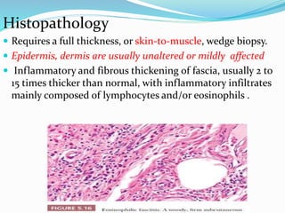 Histopathology
 Requires a full thickness, or skin-to-muscle, wedge biopsy.
 Epidermis, dermis are usually unaltered or mildly affected
 Inflammatory and fibrous thickening of fascia, usually 2 to
15 times thicker than normal, with inflammatory infiltrates
mainly composed of lymphocytes and/or eosinophils .
 