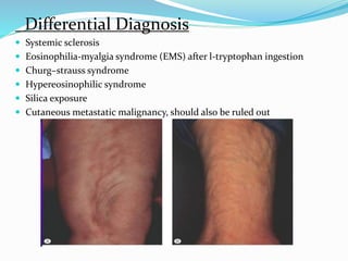 Differential Diagnosis
 Systemic sclerosis
 Eosinophilia-myalgia syndrome (EMS) after l-tryptophan ingestion
 Churg–strauss syndrome
 Hypereosinophilic syndrome
 Silica exposure
 Cutaneous metastatic malignancy, should also be ruled out
 
