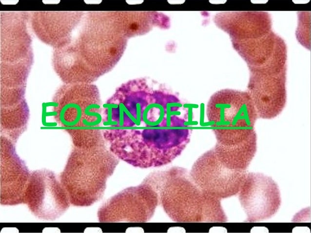 Eosinofilia
