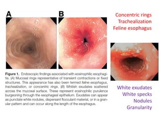 Concentric rings
Trachealization
Feline esophagus
White exudates
White specks
Nodules
Granularity
 