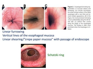 Linear furrowing
Vertical lines of the esophageal mucosa
Linear shearing/”crepe paper mucosa” with passage of endoscope
Schatzki ring
 