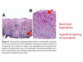 Basal zone
hyperplasia
Superficial layering
of eosinophils
 
