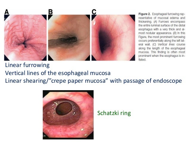 Eosinophilic esophagitis and budesonide