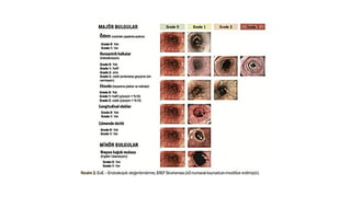 Comprehensive Overview of Eosinophilic Esophagitis: Diagnosis ...