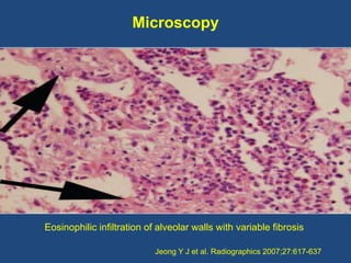 Microscopy




Eosinophilic infiltration of alveolar walls with variable fibrosis

                            Jeong Y J e...