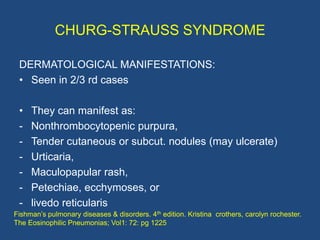 CHURG-STRAUSS SYNDROME

 GI MANIFESTATIONS:
 • Present in 60% of cases & is the 4th leading cause of
    death in CSS.

 •...