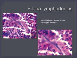 Microfilaria embedded in the
eosinophil infiltrate
Dr. Monika Nema
 