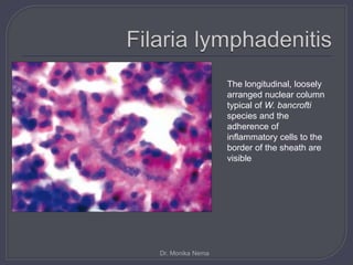 The longitudinal, loosely
arranged nuclear column
typical of W. bancrofti
species and the
adherence of
inflammatory cells to the
border of the sheath are
visible
Dr. Monika Nema
 