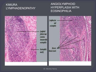 KIMURA
LYMPHADENOPATHY
ANGIOLYMPHOID
HYPERPLASIA WITH
EOSINOPHILIA
Dr. Monika Nema
 