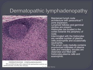 Maintained lymph node
architecture with paracortical T
zone expansion.
 Lymphoid follicles and germinal
centres are present.
 Histiocytes are located in the
cortex towards the periphery of
node.
 Intermingled with the histiocytes
are variable number of plasma
cells,eosinophils and occasionally
neutrophils.
 The lymph node medulla contains
pronounced infiltrates of plasma
cells,and medullary sinuses are
distended and filled with
histiocytes,plasma cells and
eosinophils.
Dr. Monika Nema
 