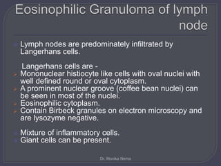  Lymph nodes are predominately infiltrated by
Langerhans cells.
Langerhans cells are -
 Mononuclear histiocyte like cells with oval nuclei with
well defined round or oval cytoplasm.
 A prominent nuclear groove (coffee bean nuclei) can
be seen in most of the nuclei.
 Eosinophilic cytoplasm.
 Contain Birbeck granules on electron microscopy and
are lysozyme negative.
 Mixture of inflammatory cells.
 Giant cells can be present.
Dr. Monika Nema
 
