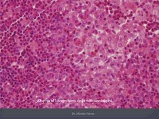Sheets of Langerhans cells with eosinophil
Sheets of Langerhans cells with eosinophil
Dr. Monika Nema
 