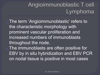 The term ‘Angioimmunoblastic’ refers to
the characteristic morphology with
prominent vascular proliferation and
increased numbers of immunoblasts
throughout the node.
The immunoblasts are often positive for
EBV by in situ hybridization and EBV PCR
on nodal tissue is positive in most cases
Dr. Monika Nema
 