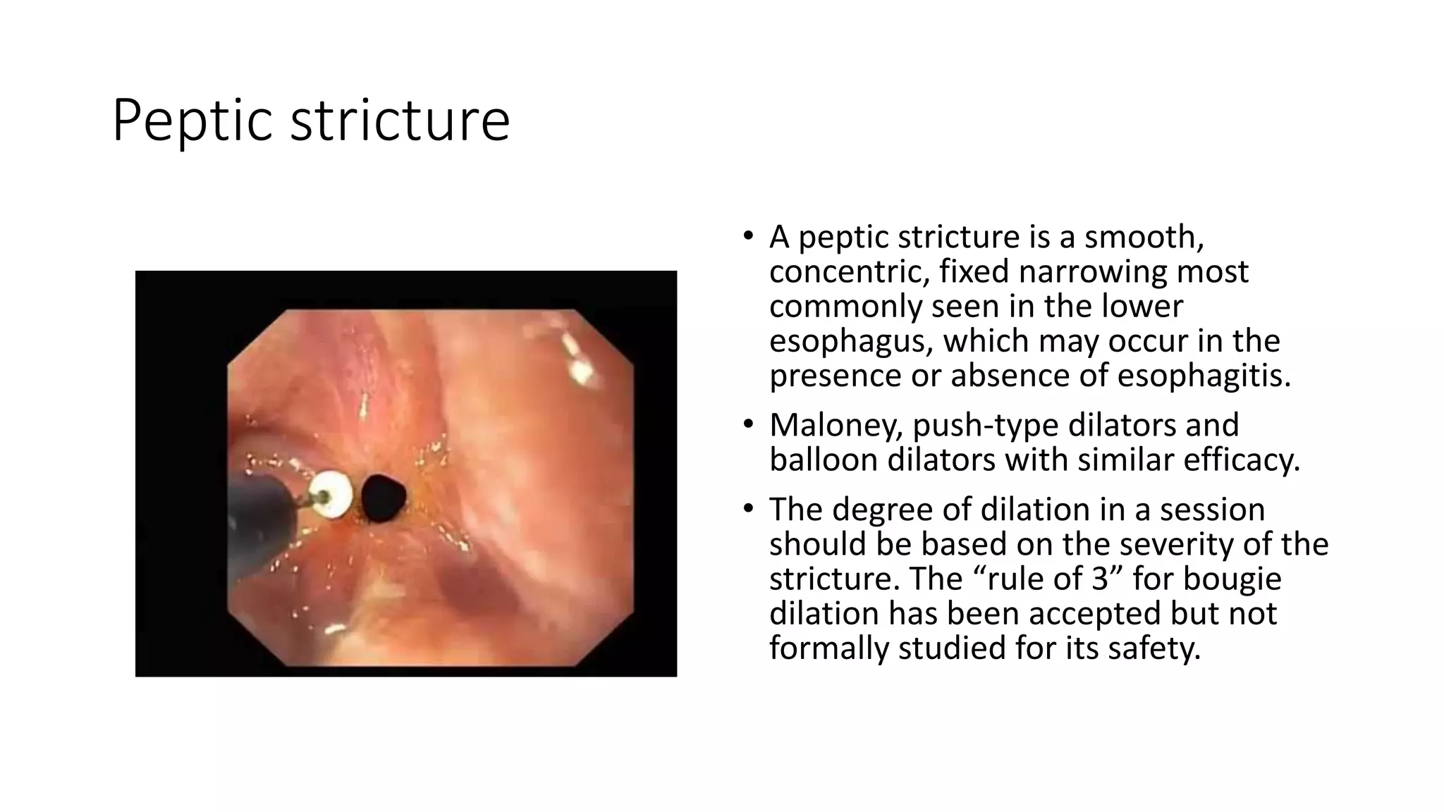 Peptic stricture
• A peptic stricture is a smooth,
concentric, fixed narrowing most
commonly seen in the lower
esophagus, which may occur in the
presence or absence of esophagitis.
• Maloney, push-type dilators and
balloon dilators with similar efficacy.
• The degree of dilation in a session
should be based on the severity of the
stricture. The “rule of 3” for bougie
dilation has been accepted but not
formally studied for its safety.
 