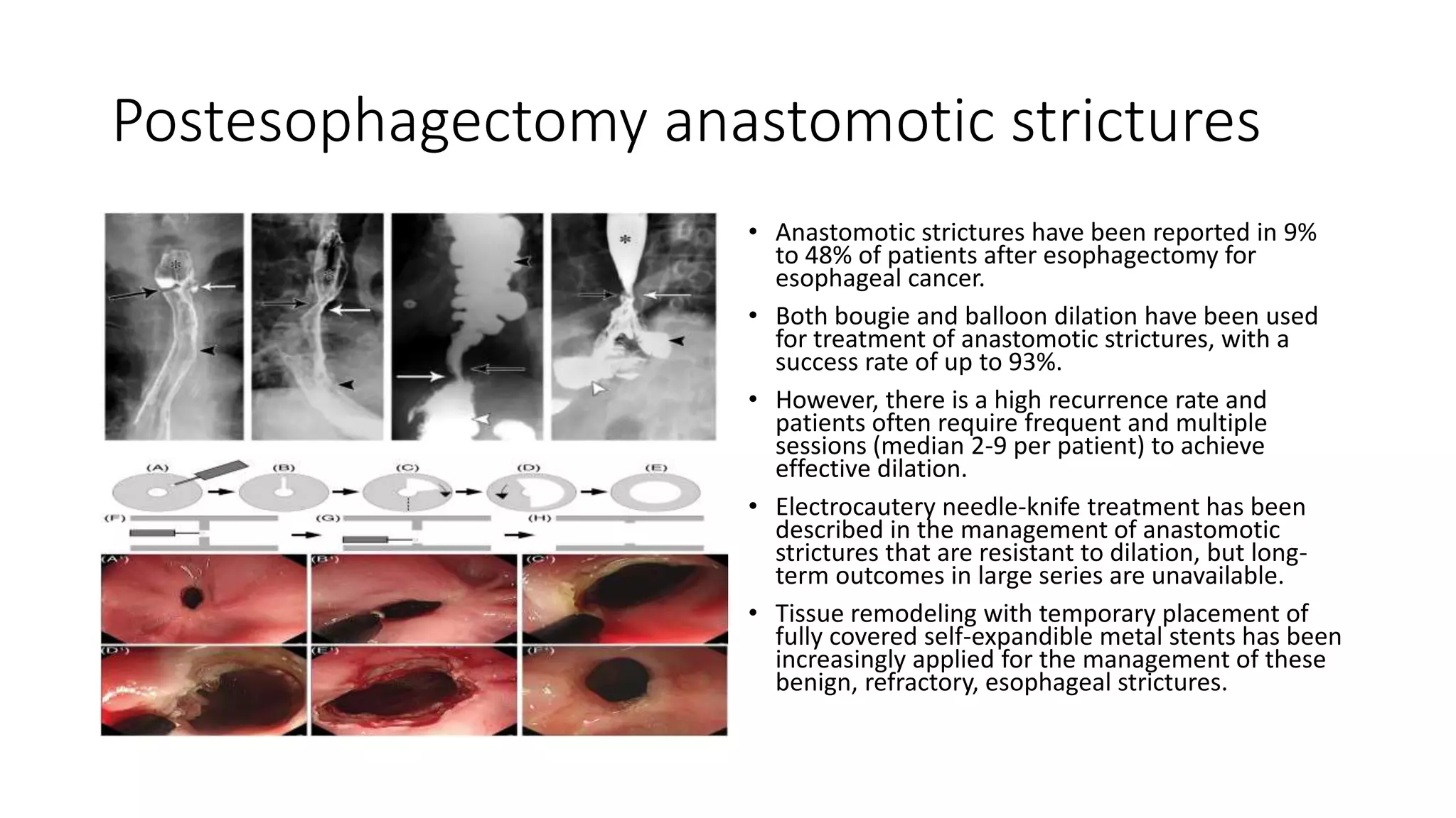 Postesophagectomy anastomotic strictures
• Anastomotic strictures have been reported in 9%
to 48% of patients after esophagectomy for
esophageal cancer.
• Both bougie and balloon dilation have been used
for treatment of anastomotic strictures, with a
success rate of up to 93%.
• However, there is a high recurrence rate and
patients often require frequent and multiple
sessions (median 2-9 per patient) to achieve
effective dilation.
• Electrocautery needle-knife treatment has been
described in the management of anastomotic
strictures that are resistant to dilation, but long-
term outcomes in large series are unavailable.
• Tissue remodeling with temporary placement of
fully covered self-expandible metal stents has been
increasingly applied for the management of these
benign, refractory, esophageal strictures.
 