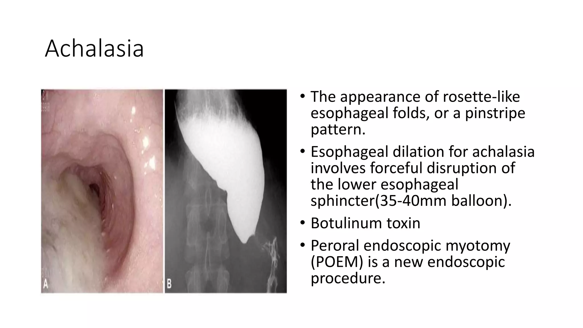Achalasia
• The appearance of rosette-like
esophageal folds, or a pinstripe
pattern.
• Esophageal dilation for achalasia
involves forceful disruption of
the lower esophageal
sphincter(35-40mm balloon).
• Botulinum toxin
• Peroral endoscopic myotomy
(POEM) is a new endoscopic
procedure.
 