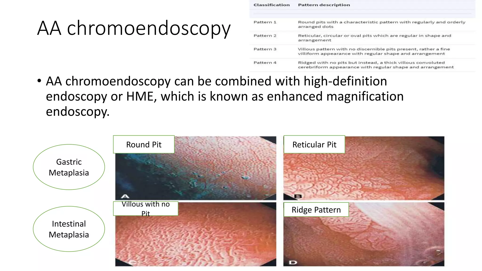 AA chromoendoscopy
• AA chromoendoscopy can be combined with high-definition
endoscopy or HME, which is known as enhanced magnification
endoscopy.
Round Pit Reticular Pit
Villous with no
Pit Ridge Pattern
Gastric
Metaplasia
Intestinal
Metaplasia
 