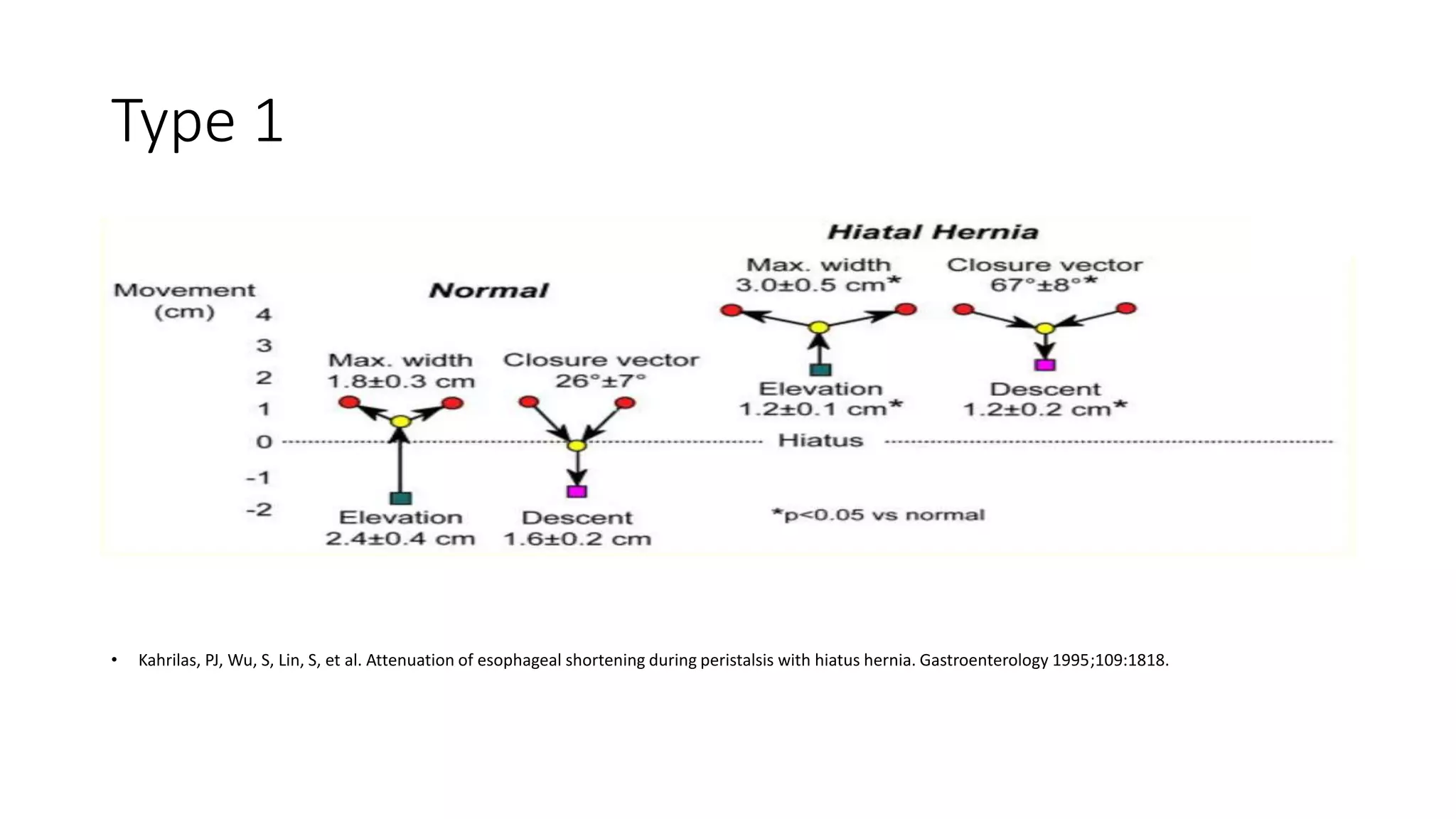 Type 1
• Kahrilas, PJ, Wu, S, Lin, S, et al. Attenuation of esophageal shortening during peristalsis with hiatus hernia. Gastroenterology 1995;109:1818.
 