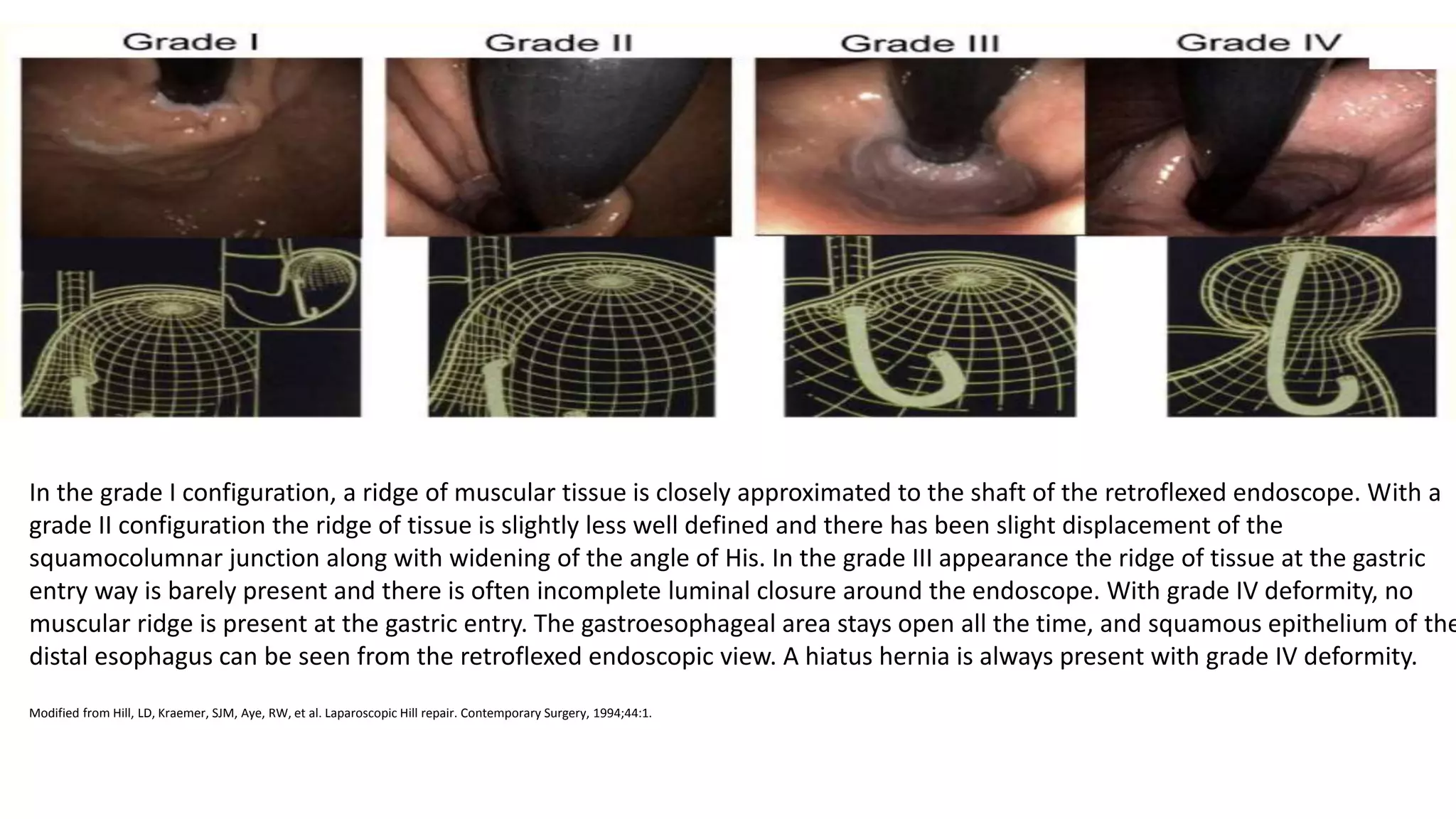 In the grade I configuration, a ridge of muscular tissue is closely approximated to the shaft of the retroflexed endoscope. With a
grade II configuration the ridge of tissue is slightly less well defined and there has been slight displacement of the
squamocolumnar junction along with widening of the angle of His. In the grade III appearance the ridge of tissue at the gastric
entry way is barely present and there is often incomplete luminal closure around the endoscope. With grade IV deformity, no
muscular ridge is present at the gastric entry. The gastroesophageal area stays open all the time, and squamous epithelium of the
distal esophagus can be seen from the retroflexed endoscopic view. A hiatus hernia is always present with grade IV deformity.
Modified from Hill, LD, Kraemer, SJM, Aye, RW, et al. Laparoscopic Hill repair. Contemporary Surgery, 1994;44:1.
 