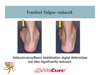 Forefoot Valgus- reduced.
Adductovarus/flexor stabilization digital deformities
are also significantly reduced.
 