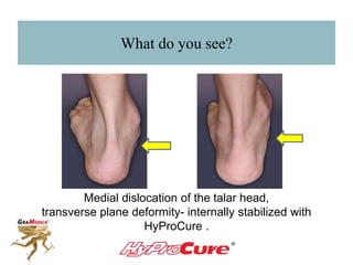 What do you see?
Medial dislocation of the talar head,
transverse plane deformity- internally stabilized with
HyProCure®
.
 