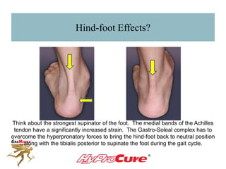 Hind-foot Effects?
The medial bands of the Achilles tendon have a significantly increased strain. The
Gastro-Soleal complex has to overcome the hyperpronatory forces to bring the
hind-foot back to neutral position along with the tibialis posterior to supinate the foot
during the gait cycle.
 