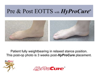 Pre & Post EOTTS with HyProCure®
Patient fully weightbearing in relaxed stance position.
This post-op photo is 3 weeks post-HyProCure®
placement.
 