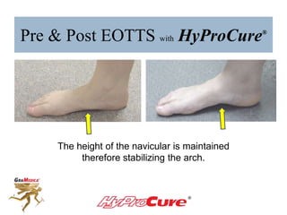 Pre & Post EOTTS with HyProCure®
The height of the navicular is maintained
therefore stabilizing the arch.
 