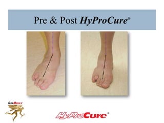 Pre & Post HyProCure®
 