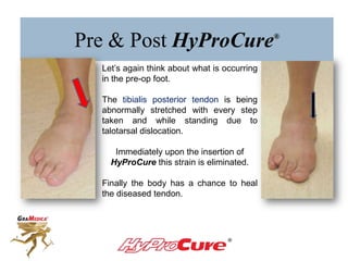 Pre & Post HyProCure®
Let’s again think about what is occurring
in the pre-op foot.
The tibialis posterior tendon is being
abnormally stretched with every step
taken and while standing due to
talotarsal dislocation.
Immediately upon the insertion of
HyProCure®
this strain is eliminated.
Finally the body has a chance to heal
the diseased tendon.
 