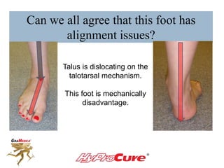 Can we all agree that this foot has
alignment issues?
Talus is dislocating on the
talotarsal mechanism.
This foot is mechanically
disadvantage.
 