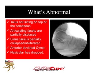 What’s Abnormal
 Talus not sitting on top of
the calcaneus
 Articulating facets are
partially displaced
 Sinus tarsi is partially
collapsed/obliterated
 Anterior deviated Cyma
 Navicular has dropped.
www.HyProCure.com
 