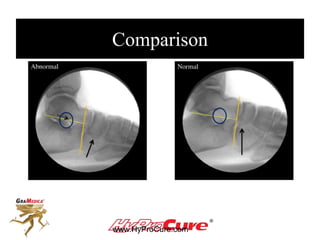 Comparison
www.HyProCure.com
 