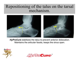 HyProCure stabilizes the talus to prevent anterior dislocation.
Maintains the articular facets, keeps the sinus open.
Repositioning of the talus on the tarsal
mechanism.
 