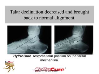 Talar declination decreased and brought
back to normal alignment.
HyProCure restores talar position on the tarsal
mechanism.
 