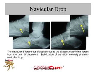 Navicular Drop
The navicular is forced out of position due to the excessive abnormal forces
from the talar displacement. Stabilization of the talus internally prevents
navicular drop.
 