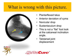 What is wrong with this picture.
• Plantarflexed talus
• Anterior deviation of cyma
• Navicular drop
• Sustentaculum drop
• This is not a “flat” foot look
at the calcaneal inclination
angle.
• Talotarsal joint
displacement
 