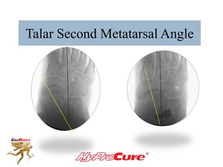 Talar Second Metatarsal Angle
 