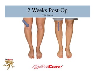 2 Weeks Post-Op
The Knees
 