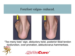 Forefoot valgus- reduced.
“Too many toes” sign, abductory twist, posterior tibial tendon
dysfunction, over-pronation, adductovarus hammertoes.
 