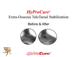 HyProCure®
Extra-Osseous TaloTarsal Stabilization
Before & After
 