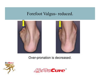 Forefoot Valgus- reduced.
Over-pronation is decreased.
 