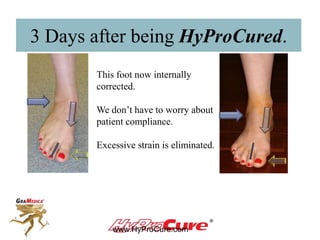 HyProCure Before & After