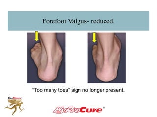 Forefoot Valgus- reduced.
“Too many toes” sign no longer present.
 