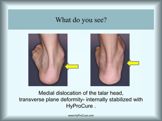 What do you see?Medial dislocation of the talar head, transverse plane deformity- internally stabilized with HyProCure .www.HyProCure.com